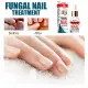 Repair Nail Smoothing Essence Onychomycosis Solution To Solve The Nail Fungus Problem On Toenails And Fingernails 50ml. 