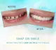 Snap On Smile Teeth One Size Fits Snapon Snap-on Smile. 