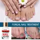 Repair Nail Smoothing Essence Onychomycosis Solution To Solve The Nail Fungus Problem On Toenails And Fingernails 50ml. 