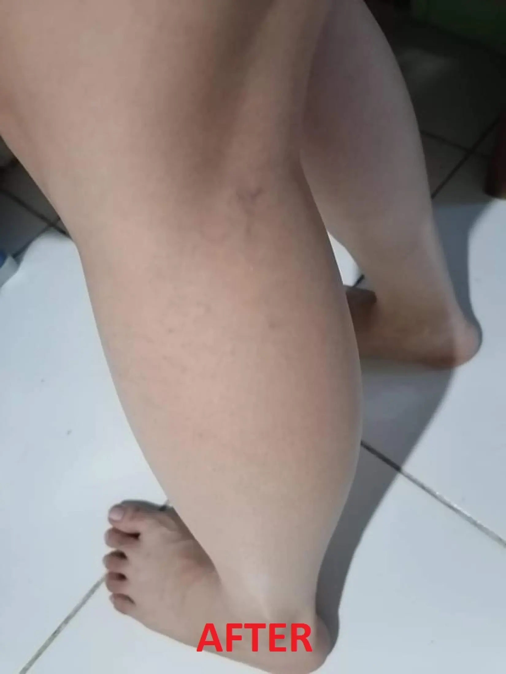 varicoza banda elastica noga)
